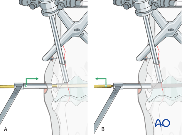 Displaced lateral condylar fracture - screw fixation