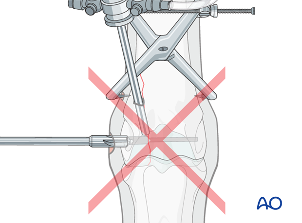Displaced lateral condylar fracture - screw fixation