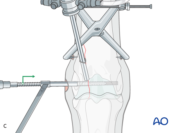 Displaced lateral condylar fracture - screw fixation