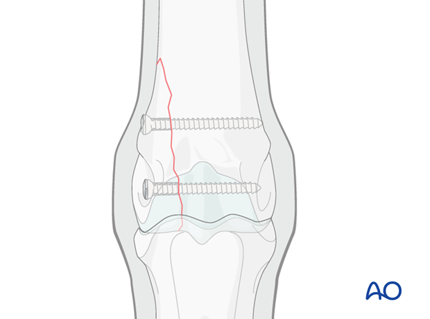 Displaced lateral condylar fracture - screw fixation
