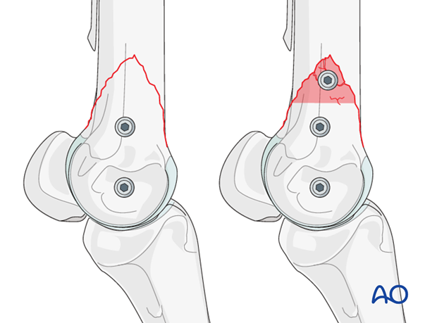 Displaced lateral condylar fracture - screw fixation