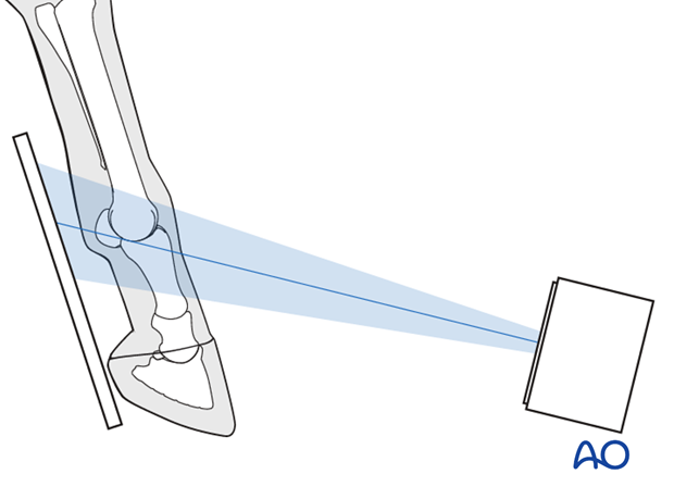 Medial spiral condylar fracture