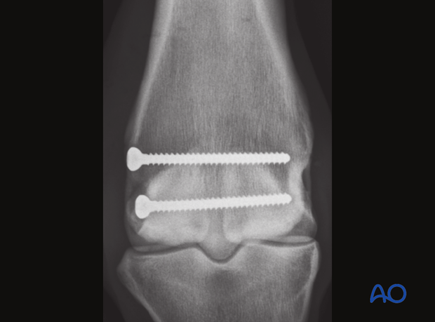 screw fixation