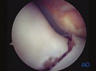 lateral condyle displaced