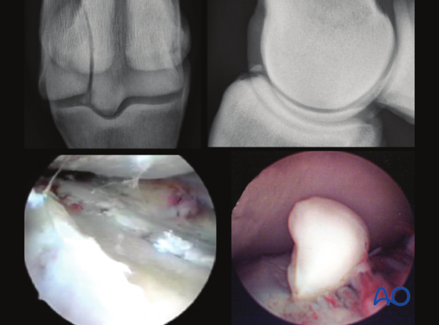 screw fixation