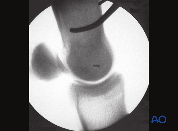 Displaced lateral condylar fracture - screw fixation