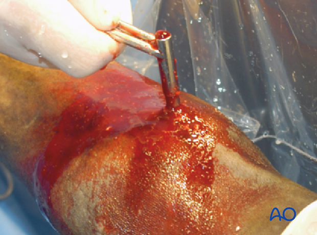 Displaced lateral condylar fracture - screw fixation