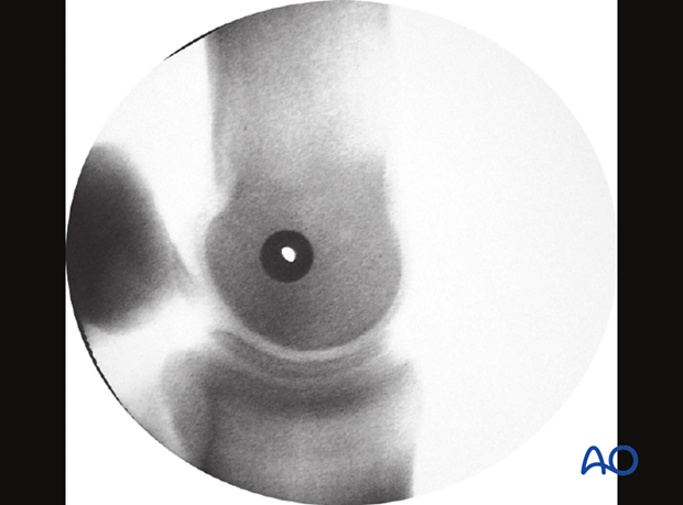 Medial incomplete condylar fracture - screw fixation