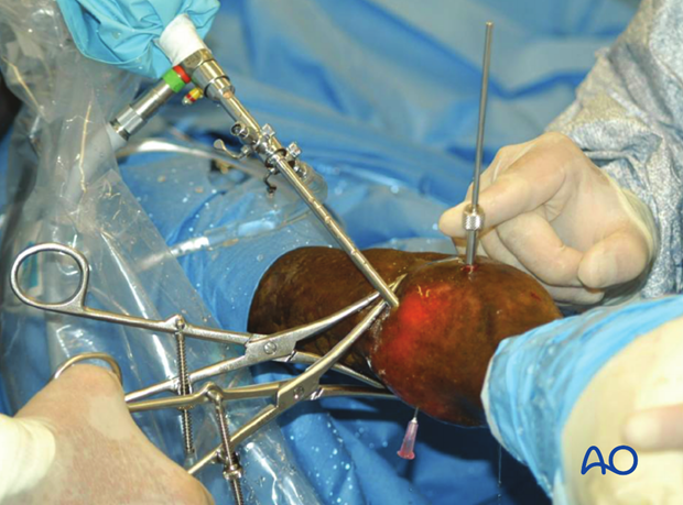 Displaced lateral condylar fracture - screw fixation
