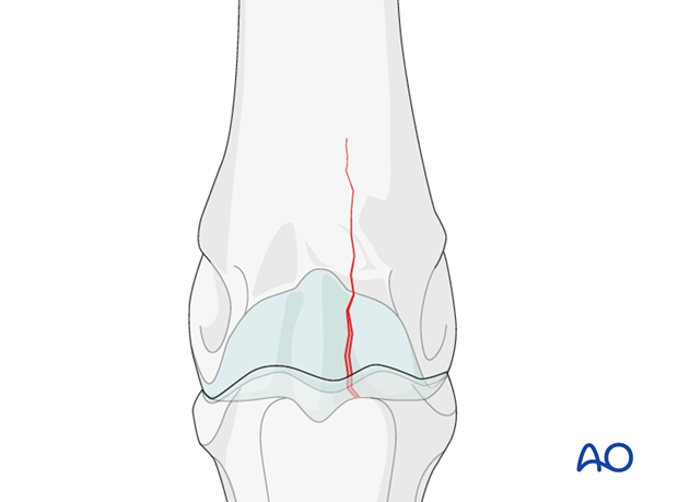 H87_C30_i100 Medial incomplete condylar fracture
