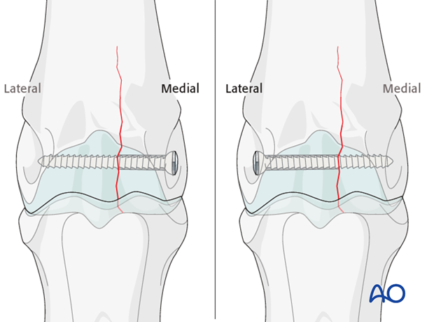 Medial incomplete condylar fracture - screw fixation