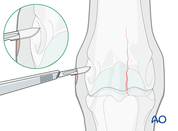 Medial incomplete condylar fracture - screw fixation