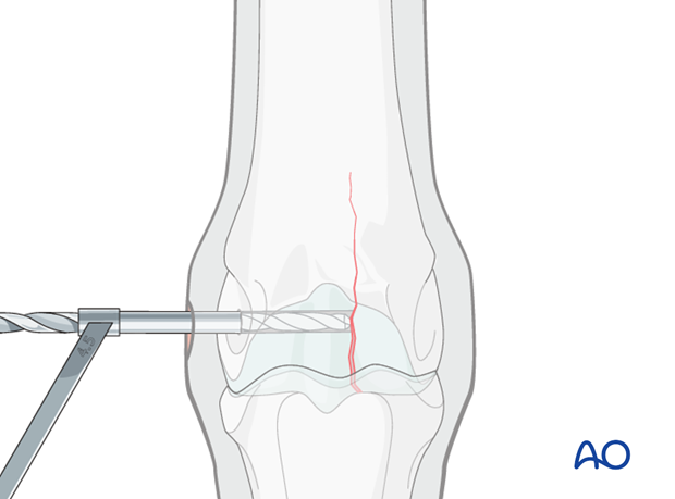 Medial incomplete condylar fracture - screw fixation