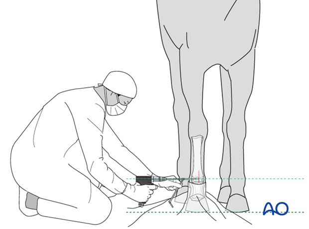 Medial incomplete condylar fracture - screw fixation