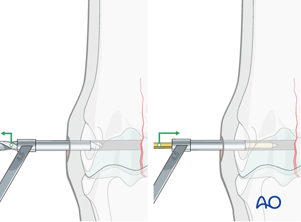 Medial incomplete condylar fracture - screw fixation