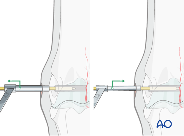 Medial incomplete condylar fracture - screw fixation