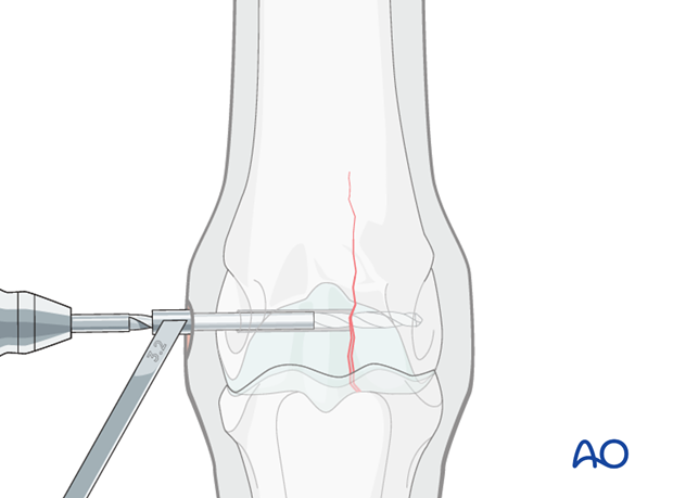 Medial incomplete condylar fracture - screw fixation