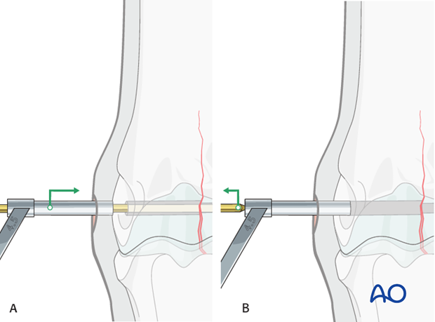 Medial incomplete condylar fracture - screw fixation