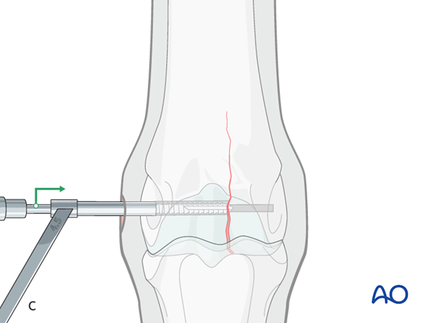 Medial incomplete condylar fracture - screw fixation