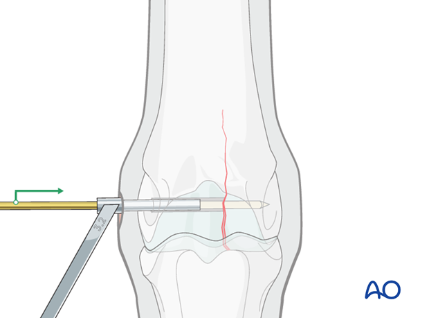 Medial incomplete condylar fracture - screw fixation