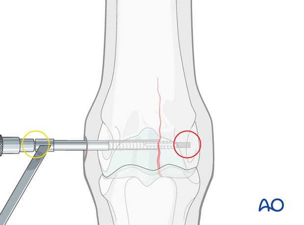 Medial incomplete condylar fracture - screw fixation