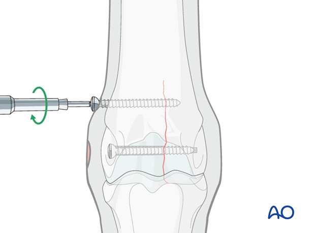 Medial incomplete condylar fracture - screw fixation
