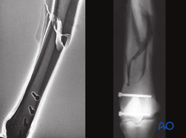 Medial incomplete condylar fracture - screw fixation