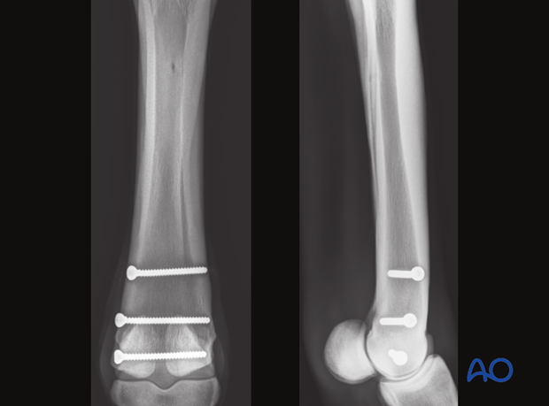 Medial incomplete condylar fracture - screw fixation