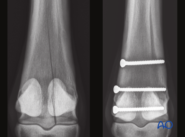 screw fixation in the standing horse