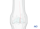 medial condyle incomplete fractures