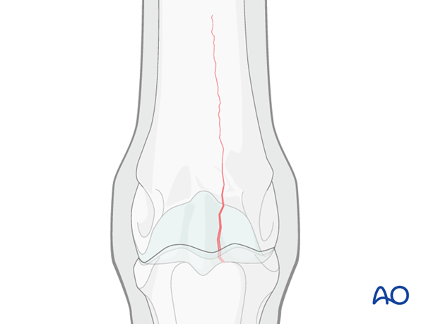 Medial incomplete condylar fracture - screw fixation