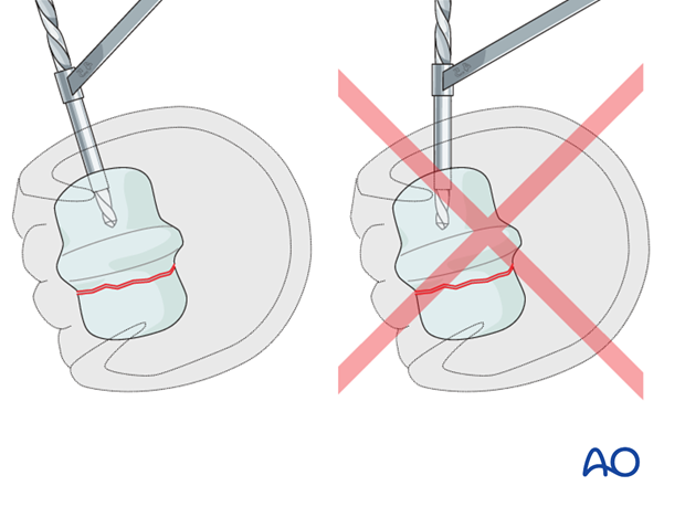 Medial incomplete condylar fracture - screw fixation