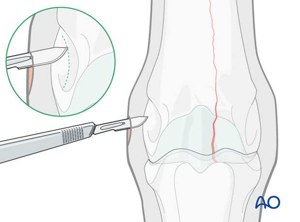 Medial incomplete condylar fracture - screw fixation