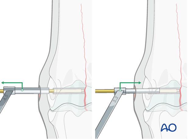 Medial incomplete condylar fracture - screw fixation