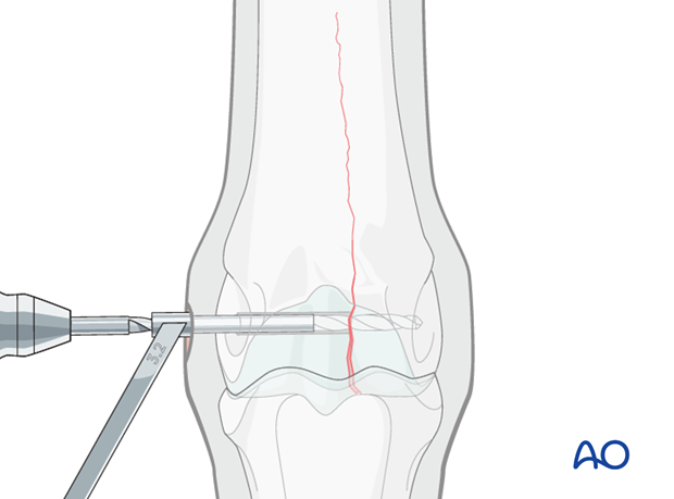 Medial incomplete condylar fracture - screw fixation