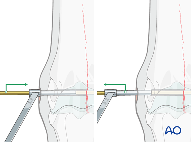Medial incomplete condylar fracture - screw fixation