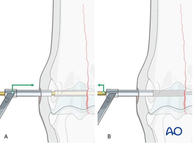 Medial incomplete condylar fracture - screw fixation