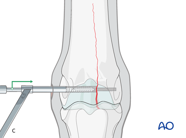 Medial incomplete condylar fracture - screw fixation