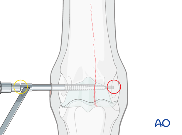 Medial incomplete condylar fracture - screw fixation