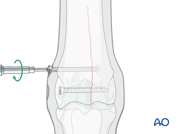 Medial incomplete condylar fracture - screw fixation