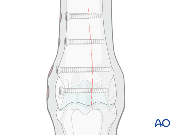 Medial incomplete condylar fracture - screw fixation