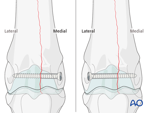 Medial incomplete condylar fracture - plate fixation
