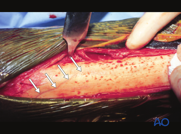 Medial incomplete condylar fracture - screw fixation