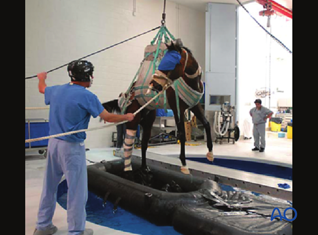 Medial incomplete condylar fracture - screw fixation