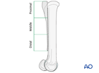 Proximal splint bone fracture - resection