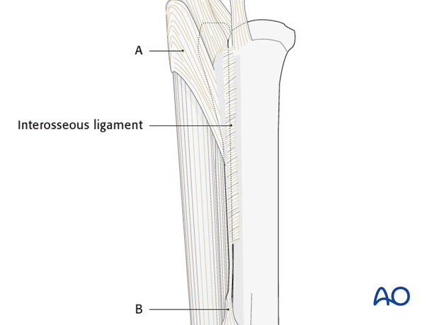 Fractures of the metacarpals/-tarsals II and IV