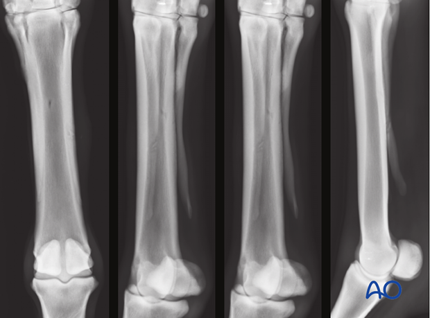Fractures of the metacarpals/-tarsals II and IV