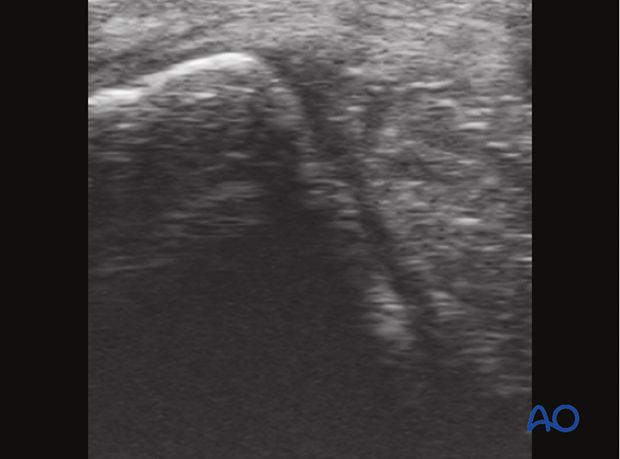 Fractures of the metacarpals/-tarsals II and IV