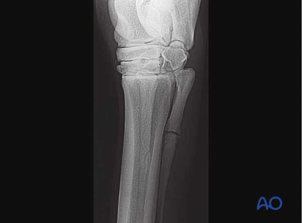 Fractures of the metacarpals/-tarsals II and IV