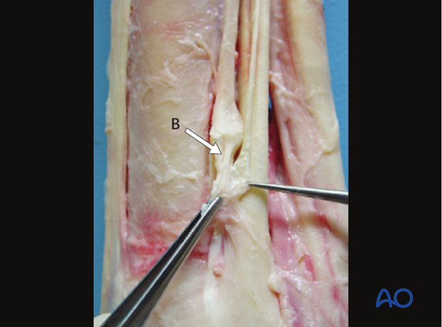 Fractures of the metacarpals/-tarsals II and IV